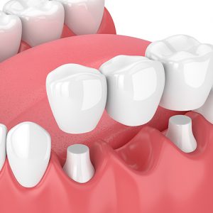 Dental Crowns At Confident Smiles