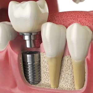 Dental Implants at Confident Smiles