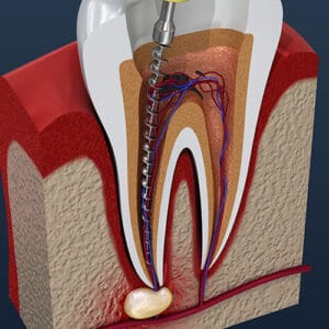 Root Canal Diagram