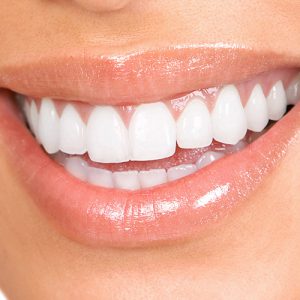 Teeth Whitening at Confident Smiles