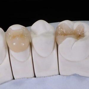 Tooth Colored Fillings